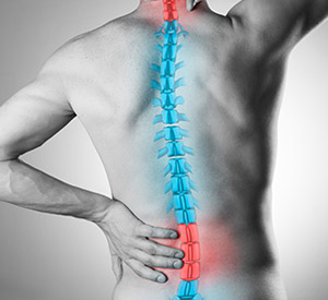 Arthritis Of The Spine at InovoSpine, Located in Houston TX